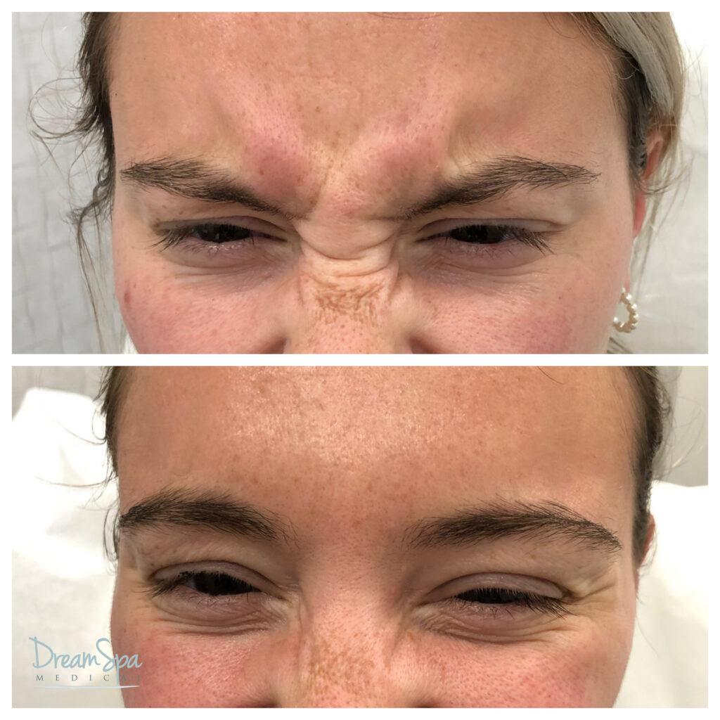 Botox before-and-after photo showing smooth, natural-looking wrinkle results with minimal treatment discomfort