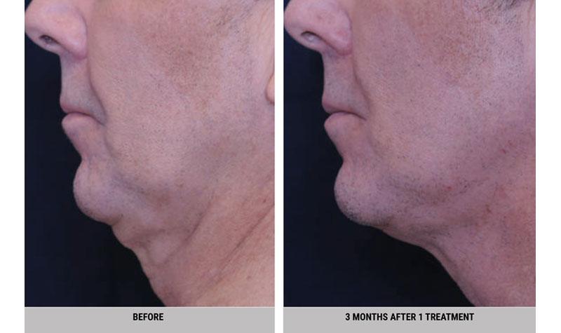 Before-and-after side profile showing improved jawline and neck definition three months after one skin-tightening treatment.