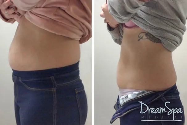 EON Body Contouring at Dream Spa Medical in Brookline, Canton and Foxborough, MA